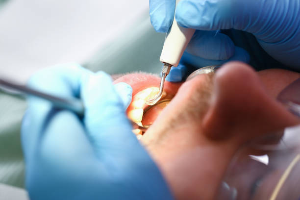 Best Emergency Root Canal Treatment in Salem, UT